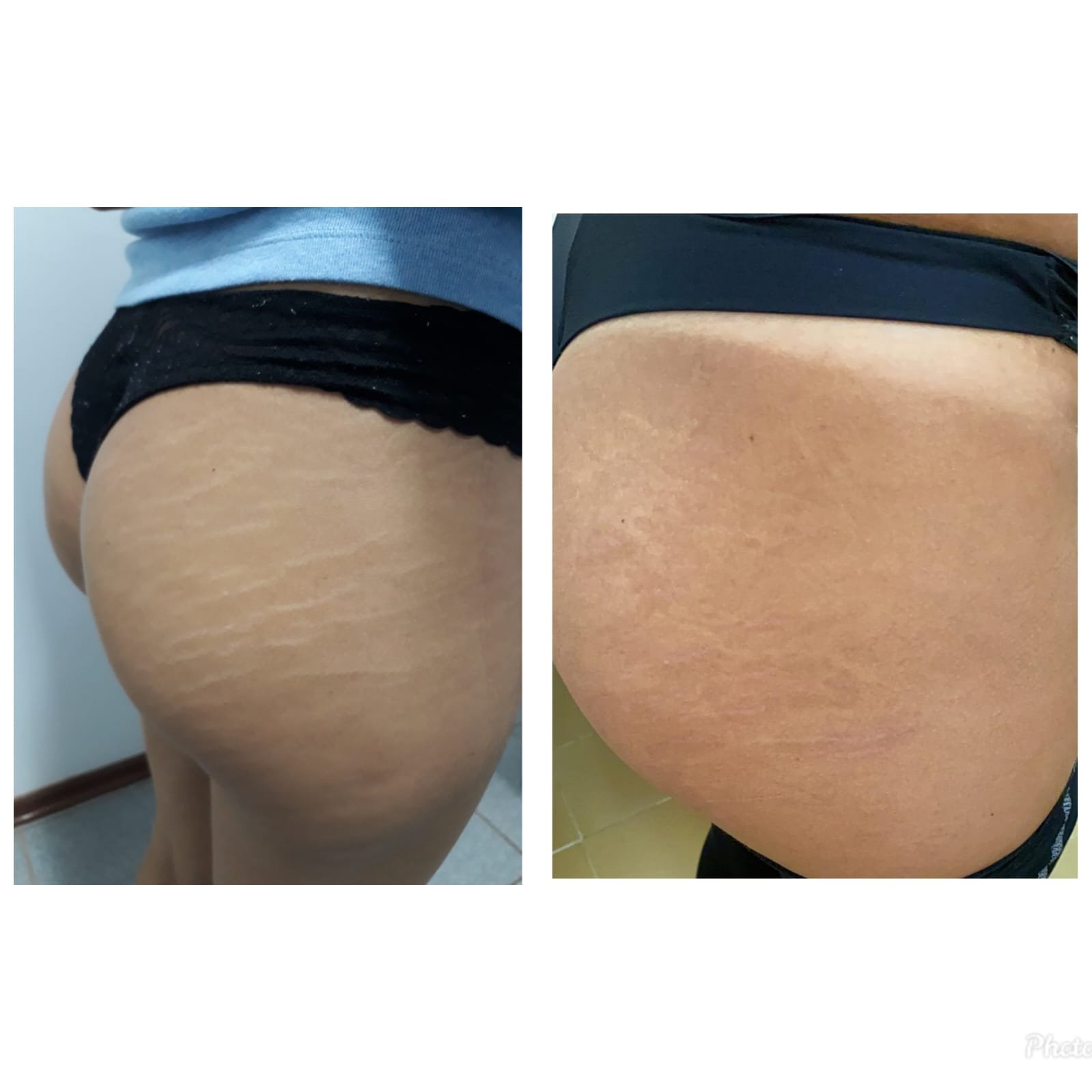 Estética Corporal